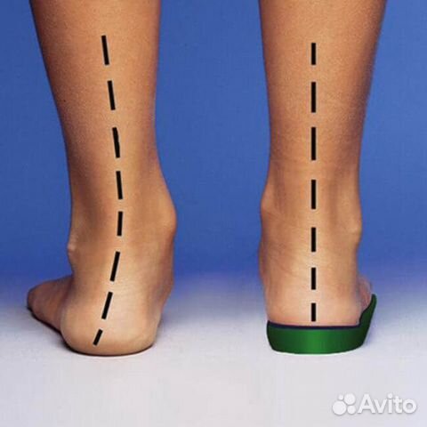 Ортопедические стельки на заказ